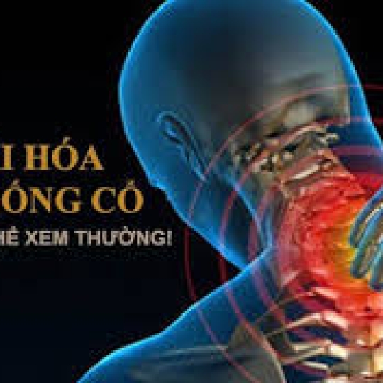 Kéo đốt sống cổ giảm mõi đau cổ gáy