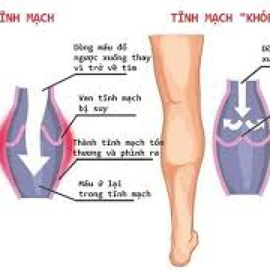 TRỊ TÊ + SUY GIÃN TĨNH MẠCH HIỆU QUẢ