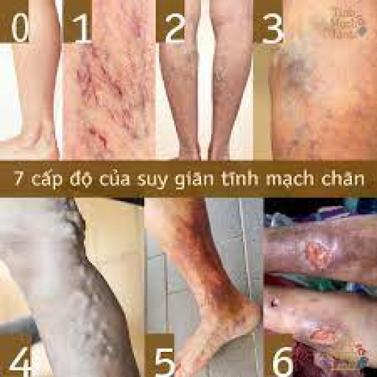 TRỊ TÊ + SUY GIÃN TĨNH MẠCH HIỆU QUẢ